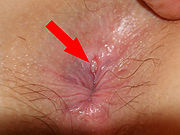 Imperforate anus