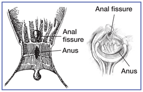 anal fissure