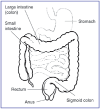 ulcerative colitis