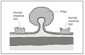 polyps